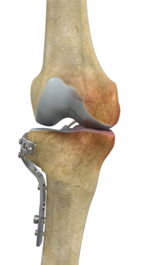 High Tibial Osteotomy