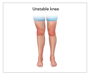 Unstable Knee