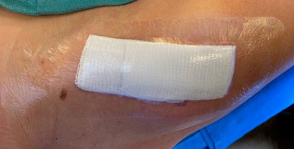 Normal bandage with gauze & clear tape over wound immediately after surgery