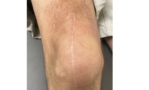 Knee wound at 18 months post-op
