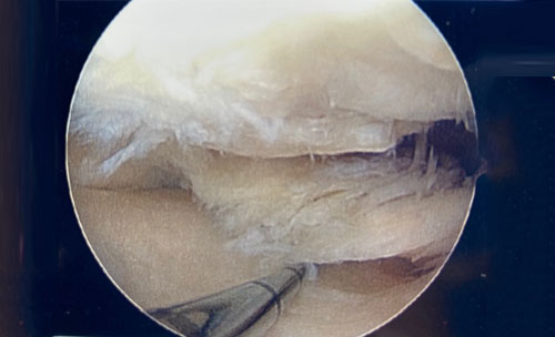 Very large meniscus tear abnormal cartilage on the bony surfaces.