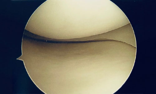 Normal Knee with smooth meniscus & smooth Cartilage Covering the Bone surfaces