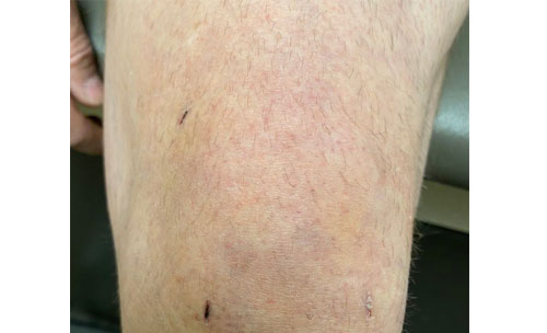 Knee arthroscopy post-op