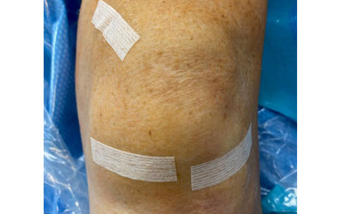 Knee arthroscopy with steri-strips in place.